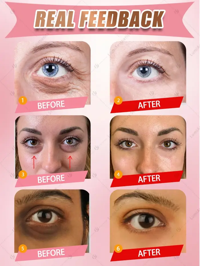 Crème pour les yeux gonflés pour les yeux foncés et défautants